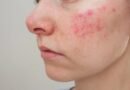Managing Chronic Skin Conditions: Best Practices and Treatments