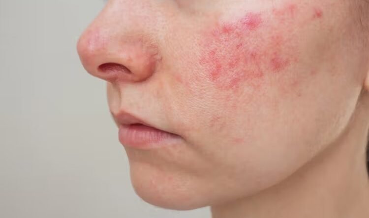 Managing Chronic Skin Conditions: Best Practices and Treatments