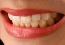 Transform Your Smile with Dental Veneers Treatment