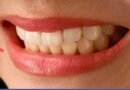 Transform Your Smile with Dental Veneers Treatment