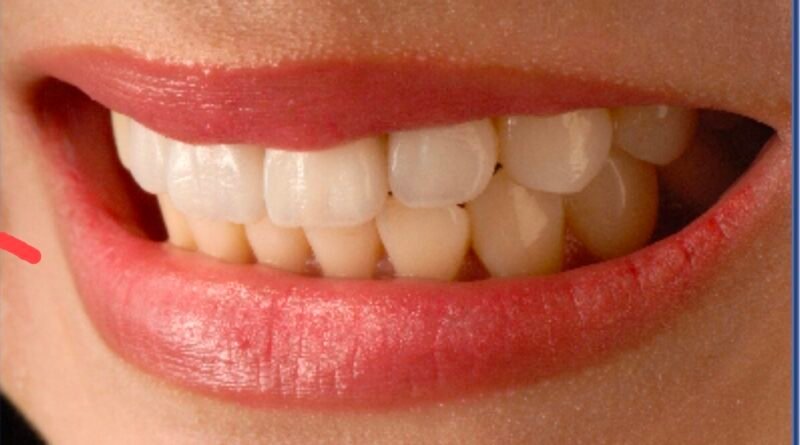 Transform Your Smile with Dental Veneers Treatment